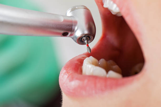 Best Emergency Dental Care for Sports Injuries in Fairlawn, VA